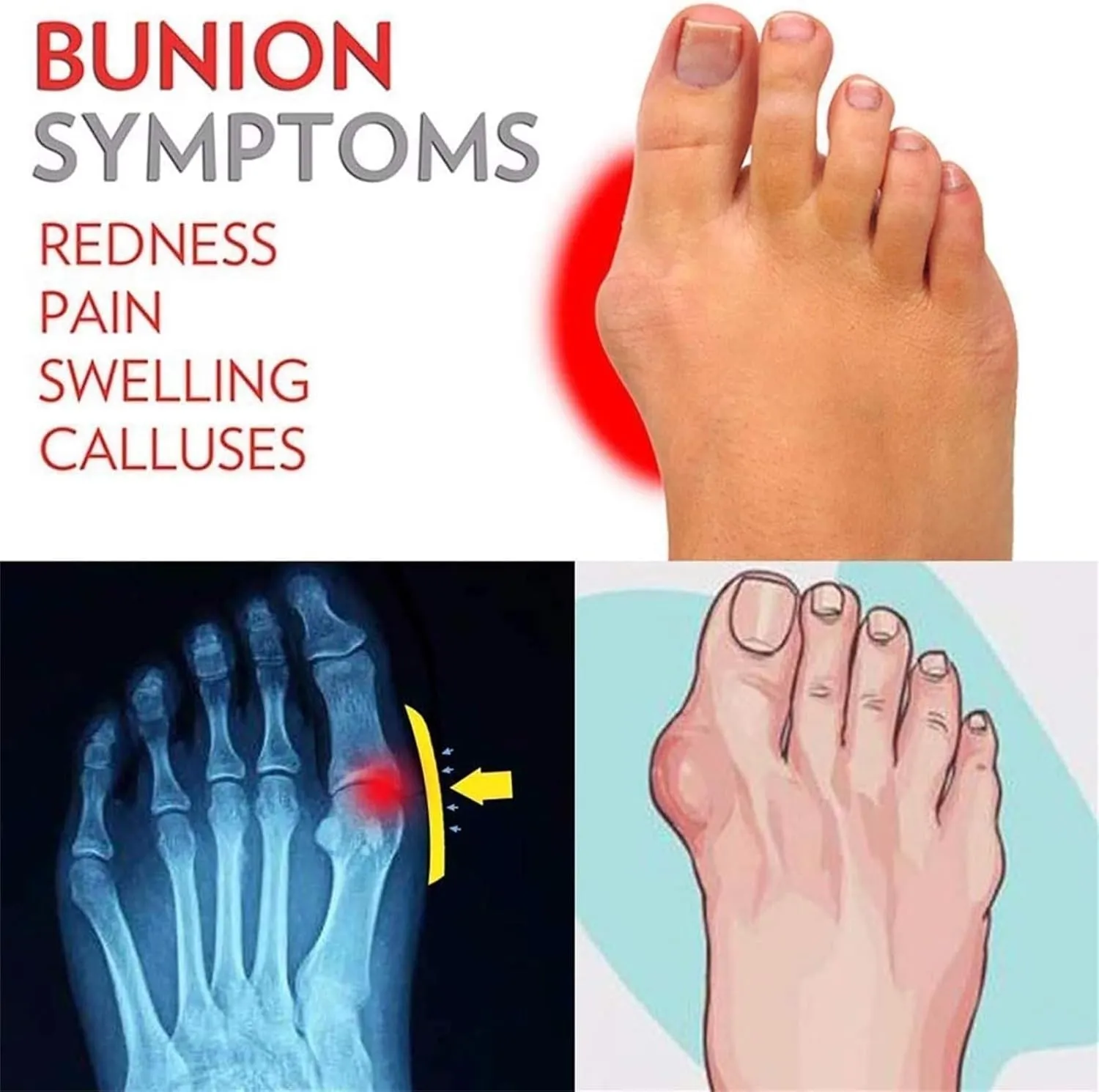 Comfortable Orthopedic Sandals, Women Fashion Retro Woven Slip-On Bunion Correction Sandals, Flat Heel Summer Casual Beach Shoes, for Big Toe Bone Correction Toe Arch Support